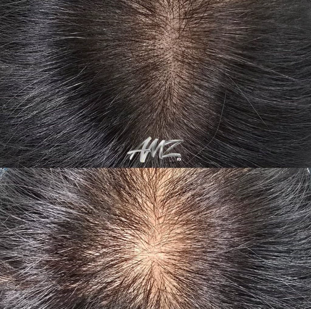 두피문신 SMP 전후사진 사례