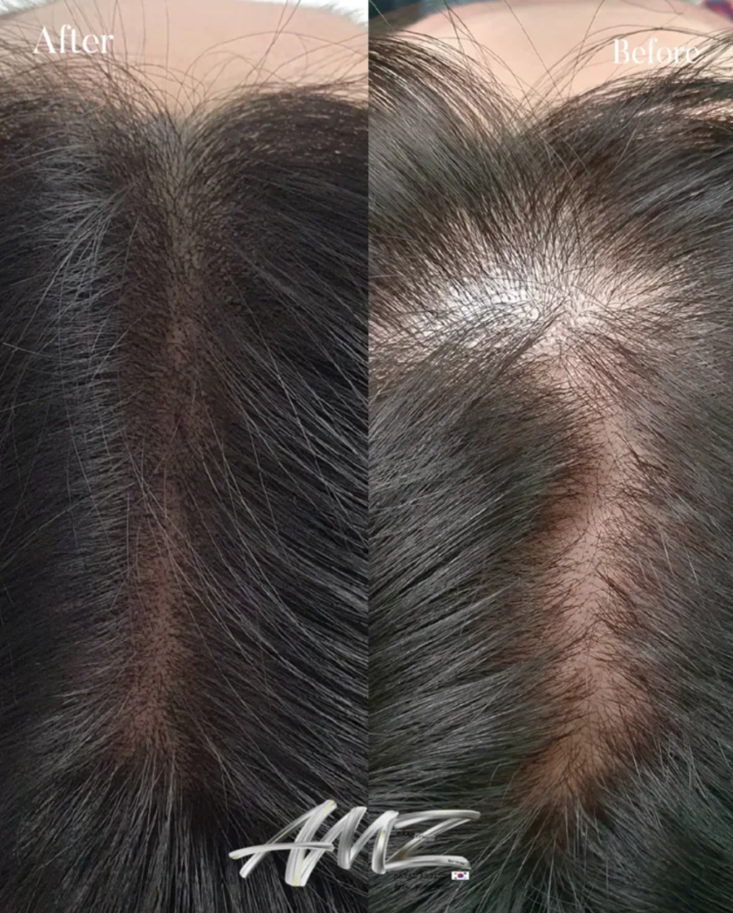 정수리 부위 두피문신 전후 사진